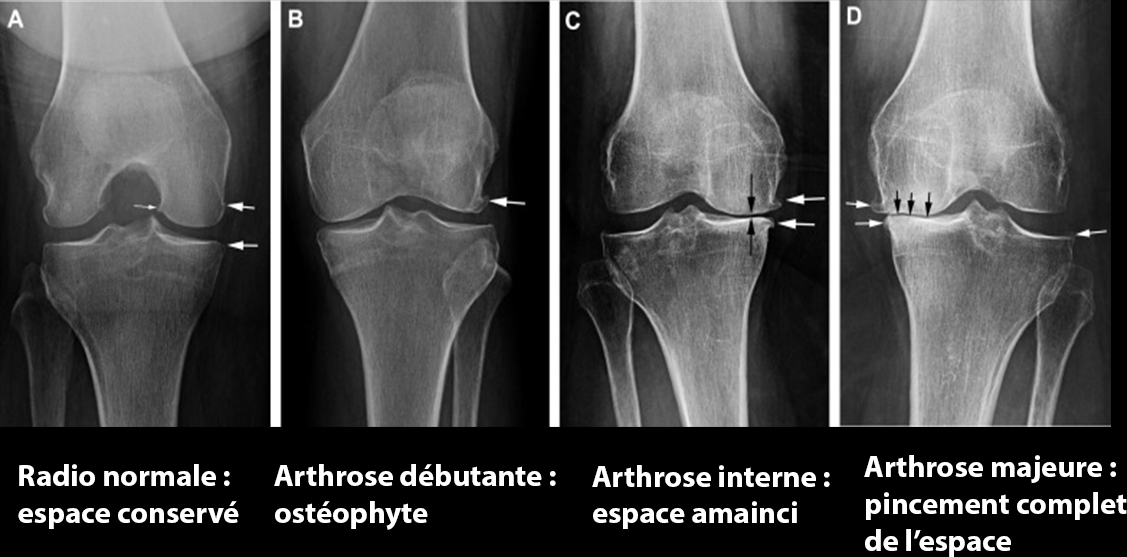 radio arthrose de genou