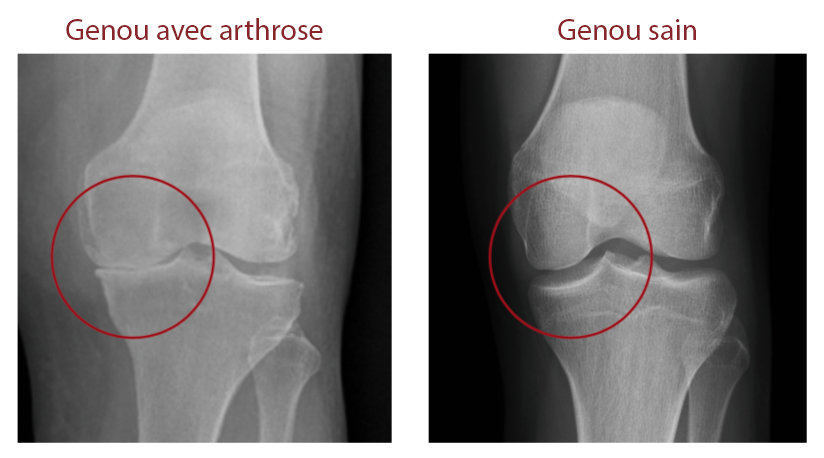 radio arthrose du genou